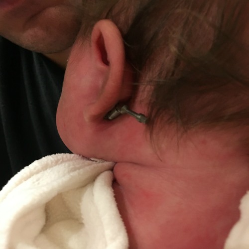 Mandibular distraction pins behind ears