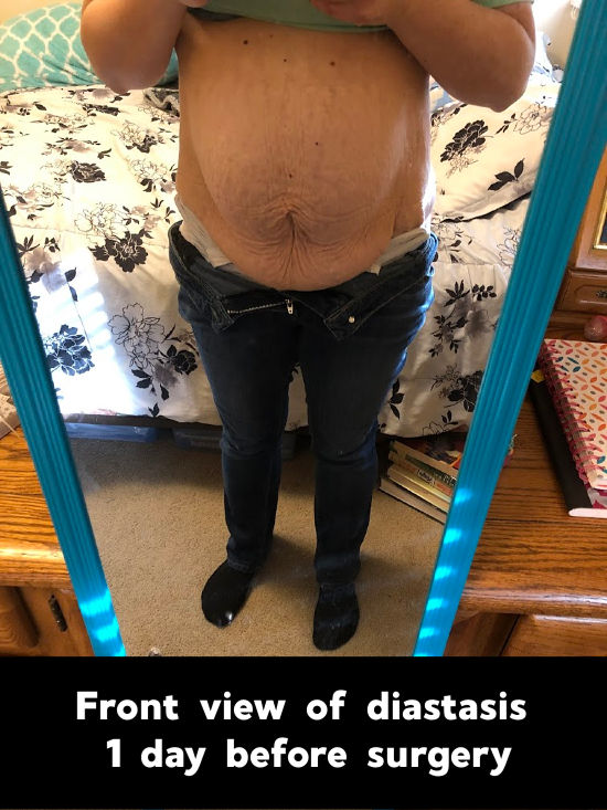 severe diastasis recti with no brace from front view - 1 day before surgery